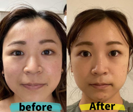 メニュー:ルート美容鍼ショートコース イメージ