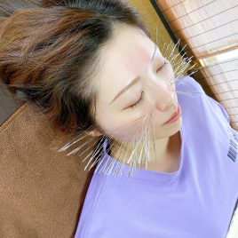 メニュー:ルート鬼美容鍼スタンダード イメージ